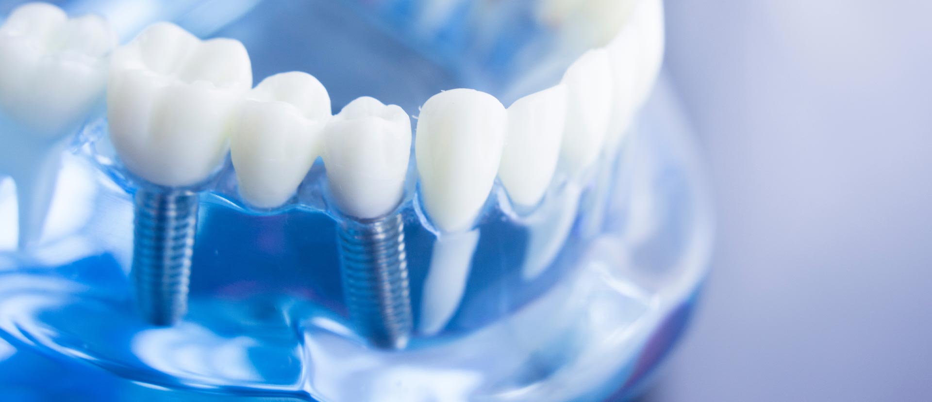 The image shows a close-up view of a dental implant fixture with screws and a clear blue background.