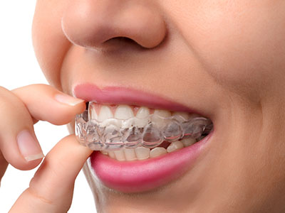 The image shows a close-up of a person s face with an Invisalign aligner in their mouth, focusing on the device which appears to be transparent and fitted over the teeth.